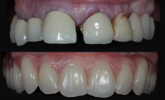 22855_Digital_Dentist_Ed_4_Blog_Thumb_1-Accuracy_328x200.png