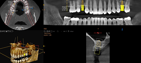 CS 8200 3D Access: 10 x 5 Implant Planning