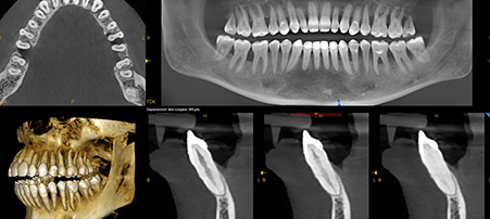 CS 8200 3D Neo Edition: 12 x 10 FOV reveals periodontitis