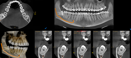 CS 8200 3D Neo Edition: 10 x 10 FOV showing impacted third molar